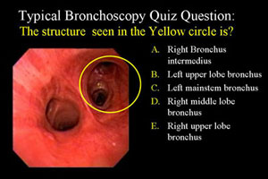 bronchoscopy quiz bronchoscopy quiz